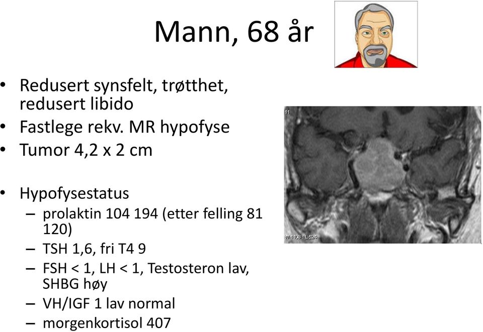 MR hypofyse Tumor 4,2 x 2 cm Hypofysestatus prolaktin 104 194