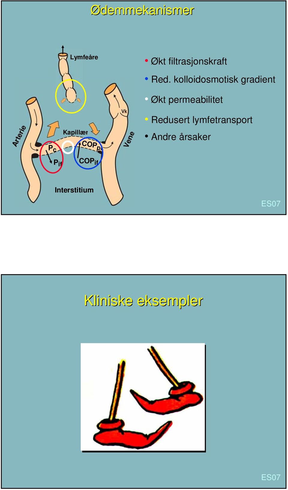 c Kapillær COP pl Vene Redusert lymfetransport Andre