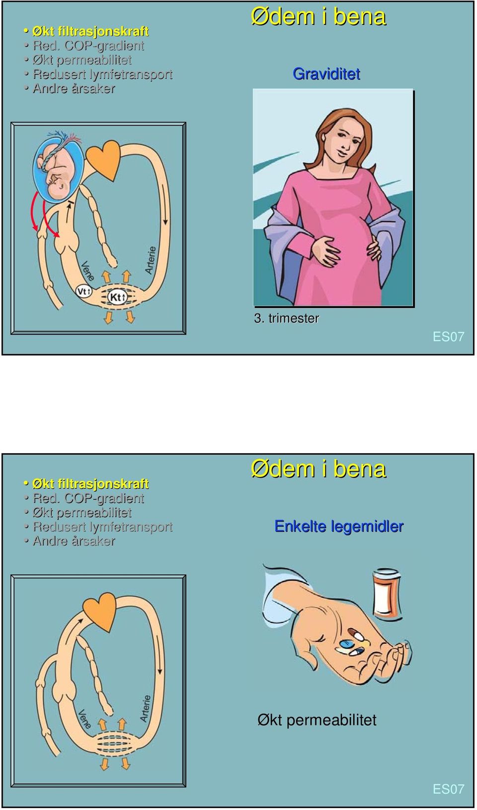 Ødem i bena Graviditet 3. trimester Økt filtrasjonskraft Red.