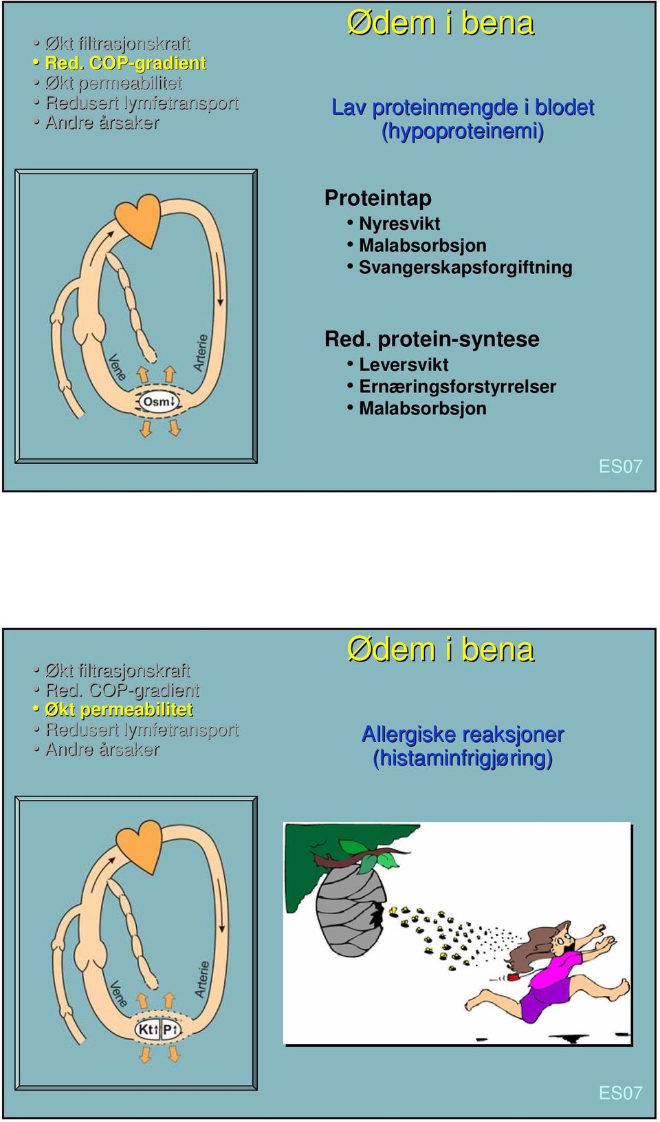 (hypoproteinemi) Proteintap Nyresvikt Malabsorbsjon Svangerskapsforgiftning Red.