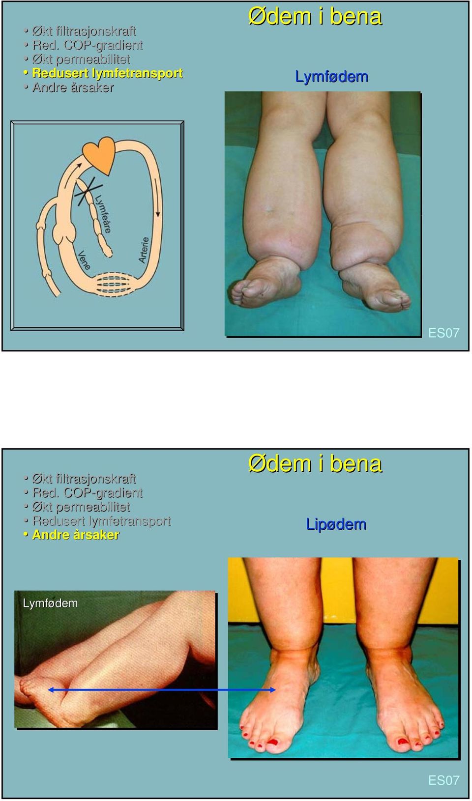 årsaker Ødem i bena Lymfødem Økt filtrasjonskraft Red.