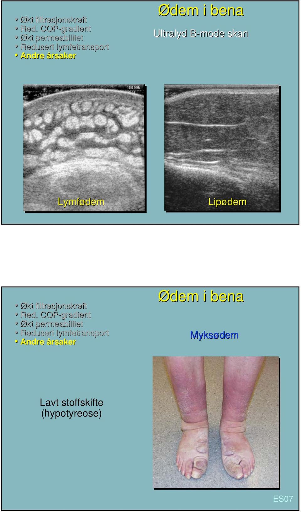 i bena Ultralyd B-mode skan Lymfødem Lipødem Økt filtrasjonskraft Red.