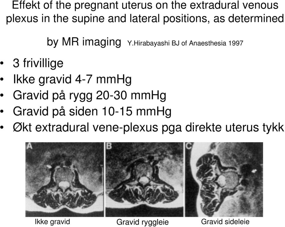 Hirabayashi BJ of Anaesthesia 1997 3 frivillige Ikke gravid 4-7 mmhg Gravid på rygg