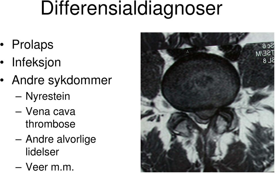 Nyrestein Vena cava thrombose