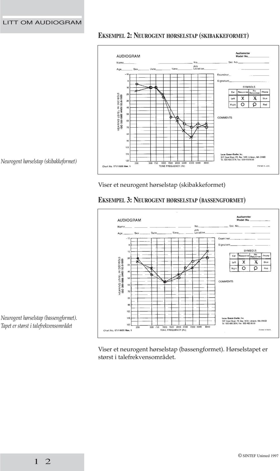 HØRSELSTAP (BASSENGFORMET) Neurogent hørselstap (bassengformet).