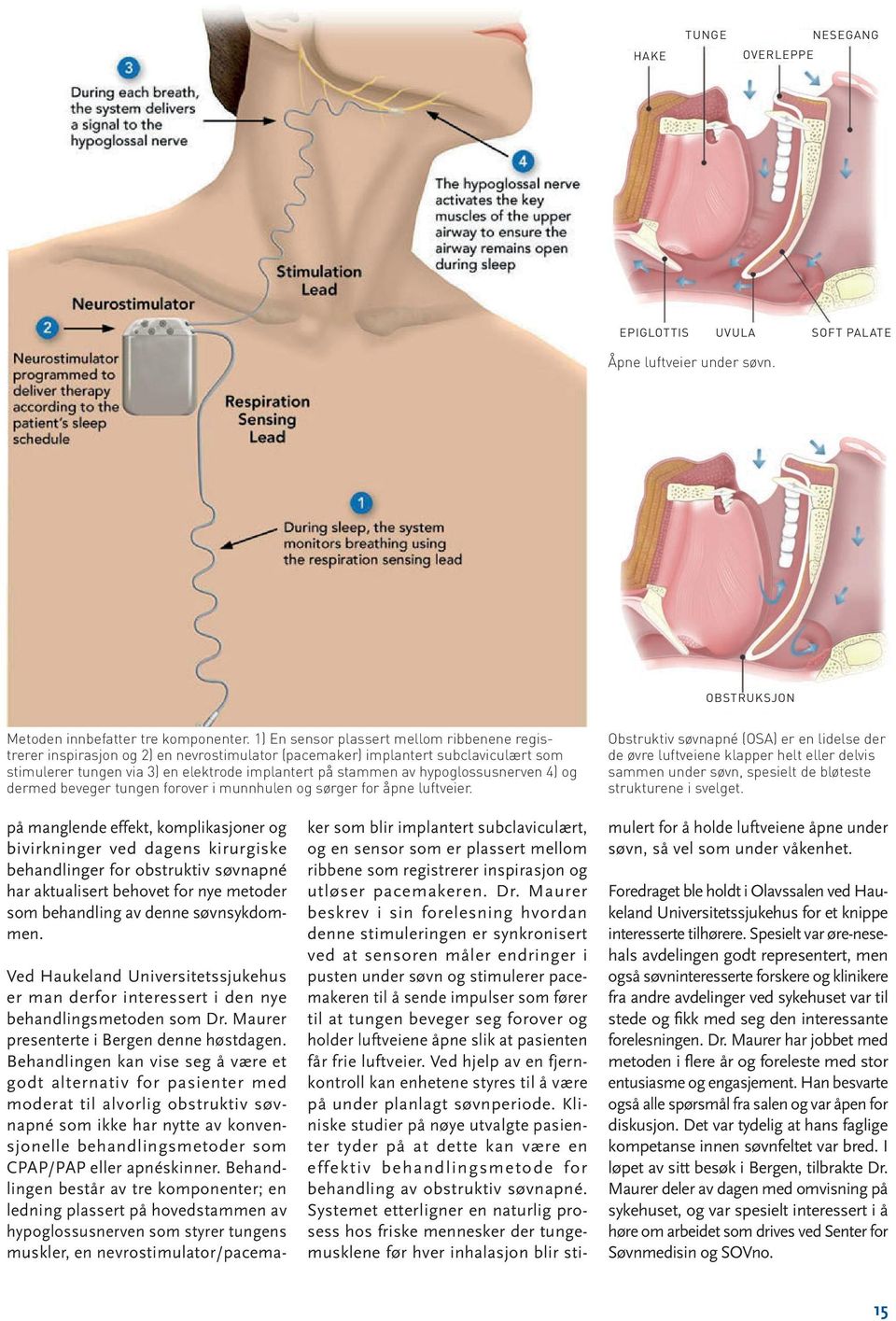 hypoglossusnerven 4) og dermed beveger tungen forover i munnhulen og sørger for åpne luftveier.