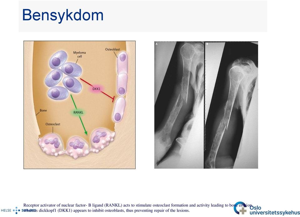 leading to bone erosion, whereas dickkopf1 (DKK1) appears