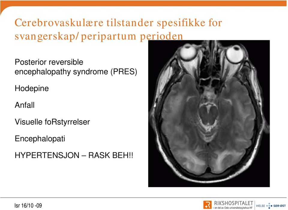 reversible encephalopathy syndrome (PRES) Hodepine