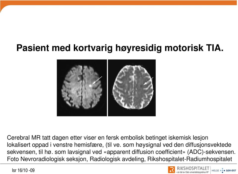 i venstre hemisfære, (til ve. som høysignal ved den diffusjonsvektede sekvensen, til hø.