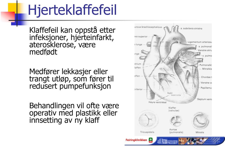 eller trangt utløp, som fører til redusert pumpefunksjon