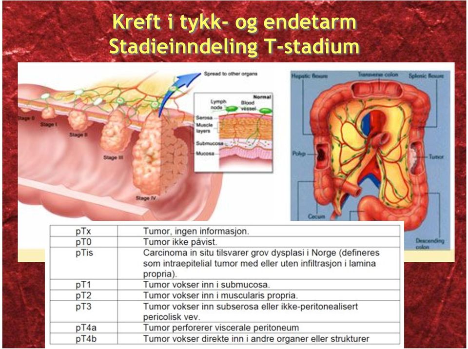 endetarm