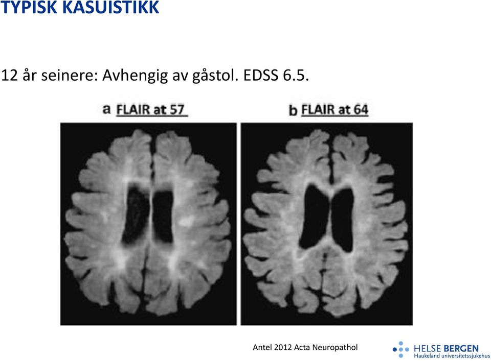 av gåstol. EDSS 6.5.