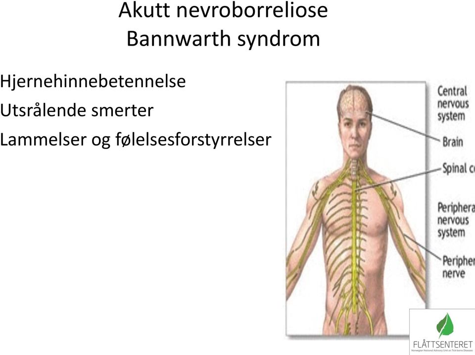 nevroborreliose Bannwarth