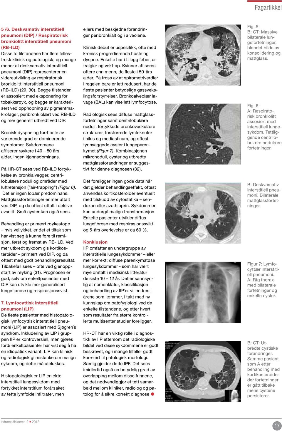interstitiell pneumoni (DIP) representerer en videreutvikling av respiratorisk bronkiolitt interstitiell pneumoni (RB-ILD) (29, 30).