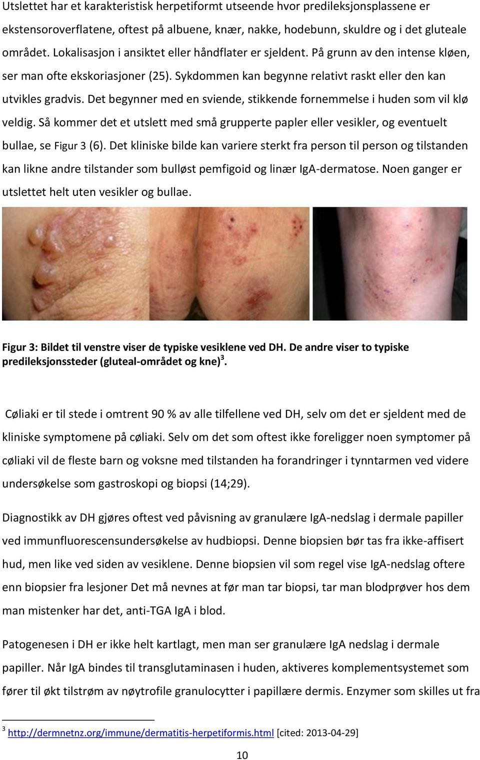 Det begynner med en sviende, stikkende fornemmelse i huden som vil klø veldig. Så kommer det et utslett med små grupperte papler eller vesikler, og eventuelt bullae, se Figur 3 (6).