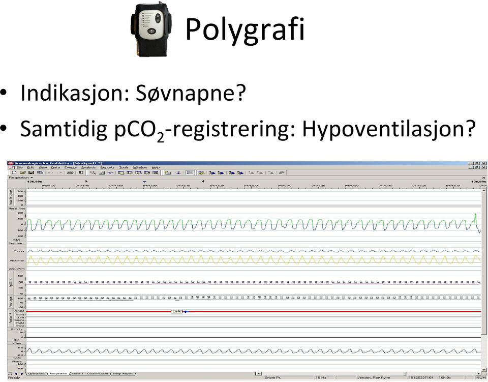 Søvnapne?