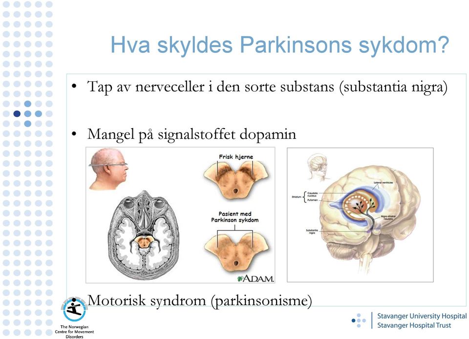 substans (substantia nigra) Mangel på