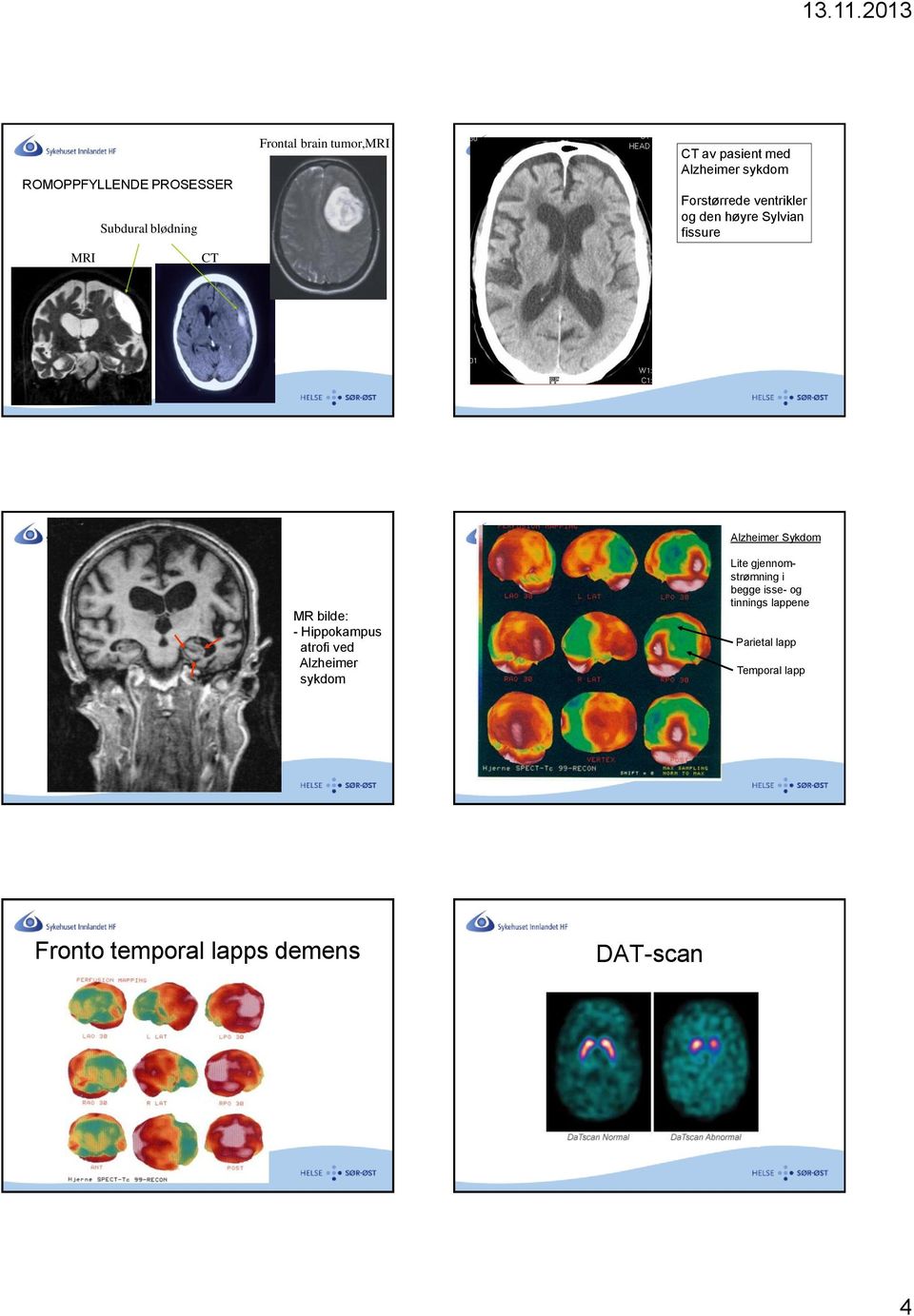 Hippokampus atrofi ved Alzheimer sykdom Alzheimer Sykdom Lite gjennomstrømning i begge