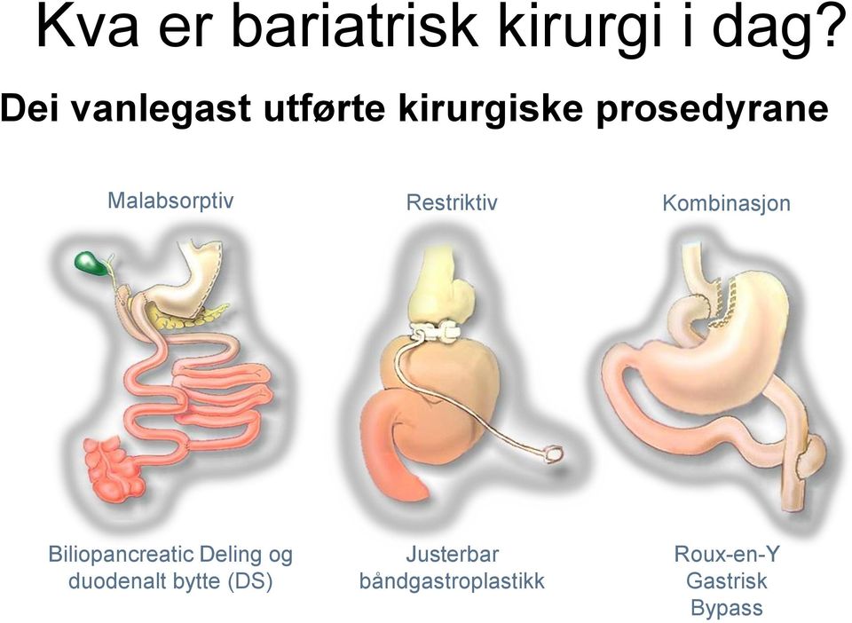 Malabsorptiv Restriktiv Kombinasjon Biliopancreatic