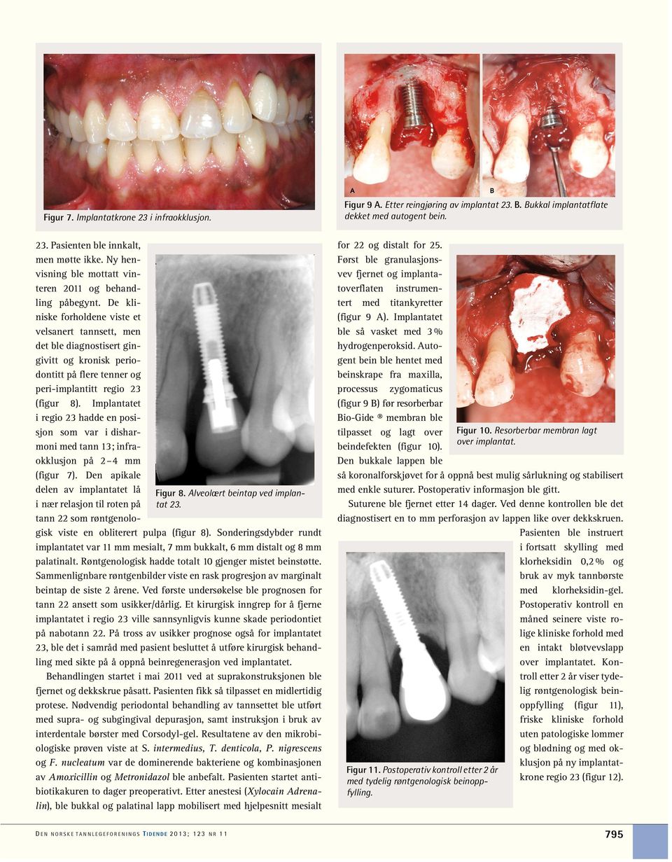 De kliniske forholdene viste et velsanert tannsett, men det ble diagnostisert gingivitt og kronisk periodontitt på flere tenner og peri-implantitt regio 23 (figur 8).