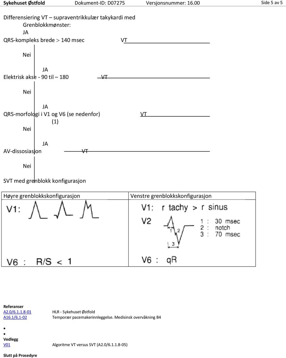 180 QRS-morfologi i V1 og V6 (se nedenfor) (1) AV-dissosiasjon S med grenblokk konfigurasjon Høyre grenblokkskonfigurasjon Venstre