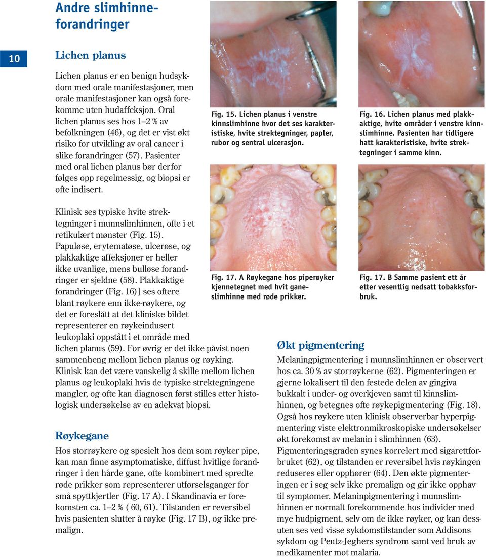 Pasienter med oral lichen planus bør derfor følges opp regelmessig, og biopsi er ofte indisert. Fig. 15.