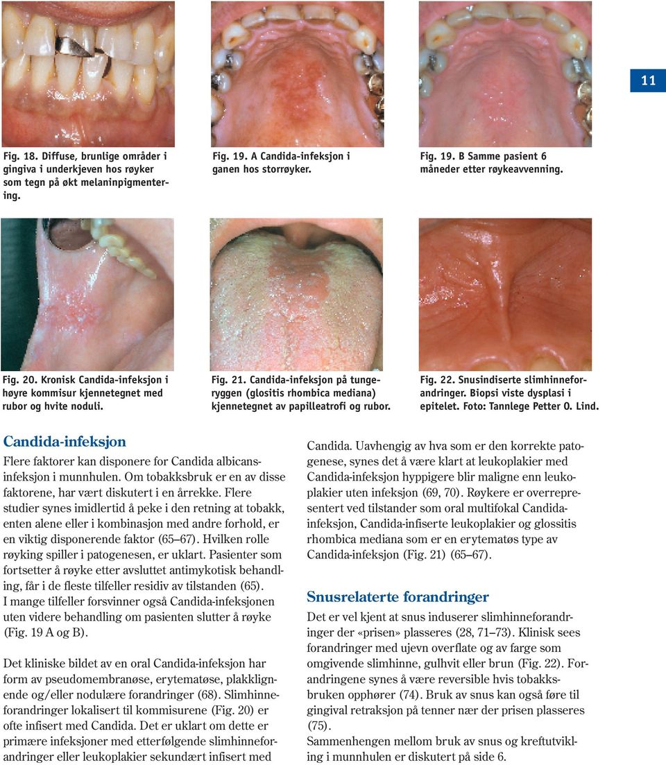 Candida-infeksjon på tungeryggen (glositis rhombica mediana) kjennetegnet av papilleatrofi og rubor. Fig. 22. Snusindiserte slimhinneforandringer. Biopsi viste dysplasi i epitelet.