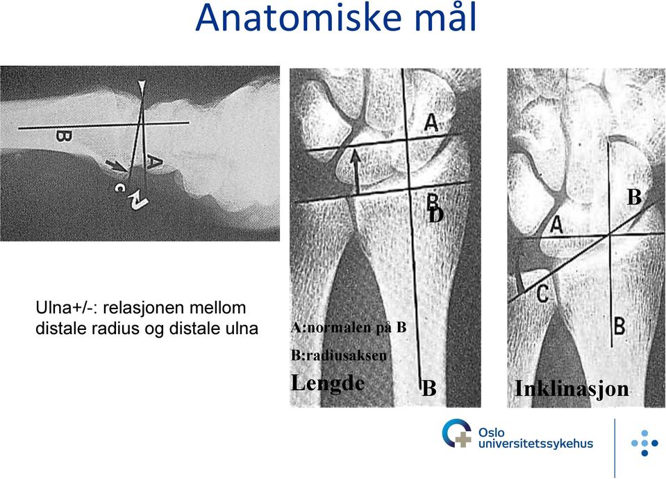 distale ulna A:normalen på B