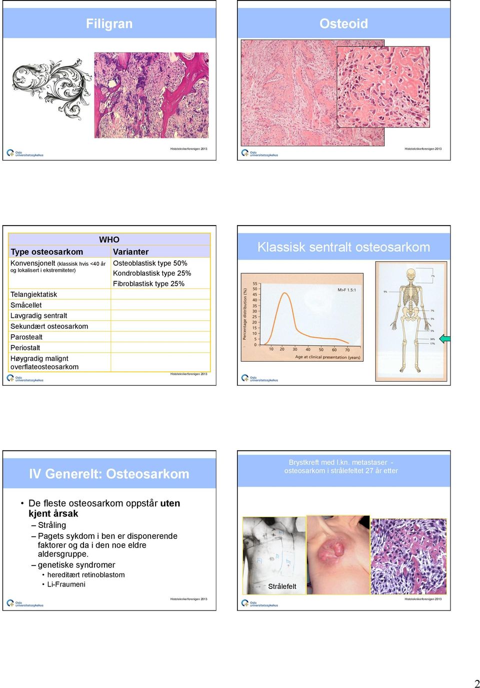 malignt overflateosteosarkom IV Generelt: Osteosarkom Brystkreft med l.kn.