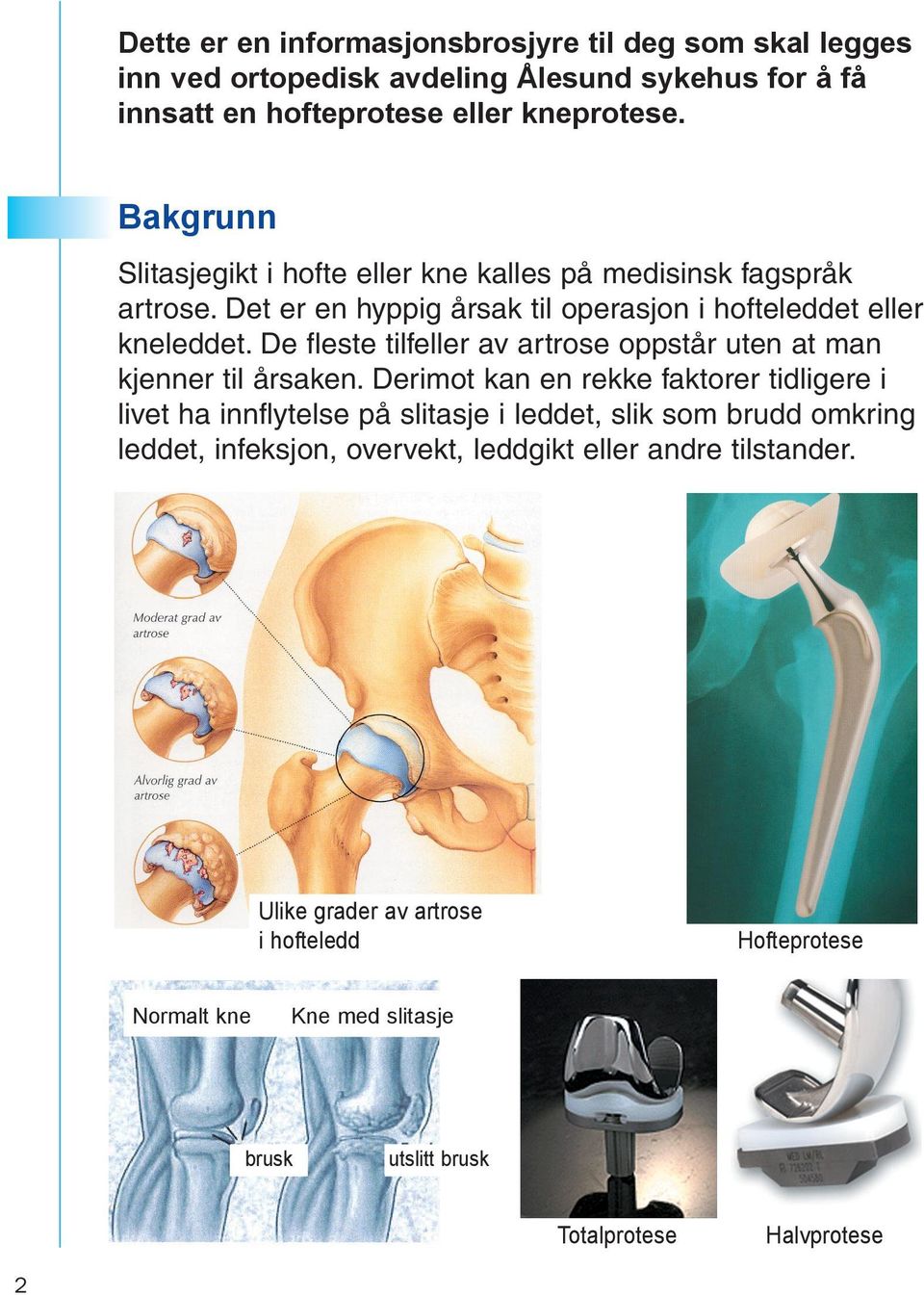 De fleste tilfeller av artrose oppstår uten at man kjenner til årsaken.