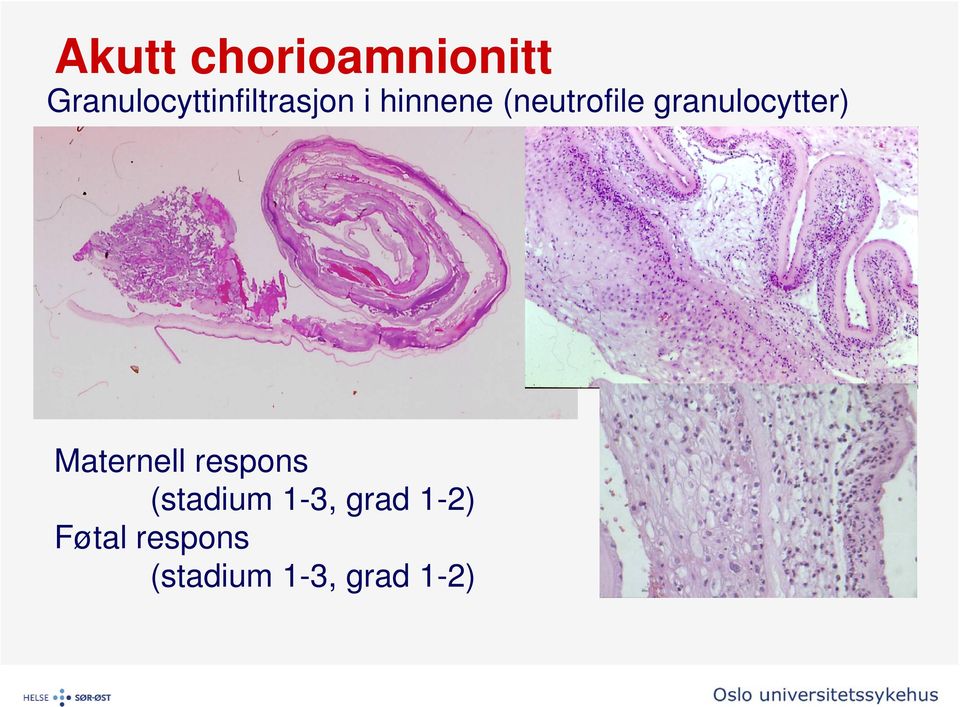 (neutrofile granulocytter) Maternell