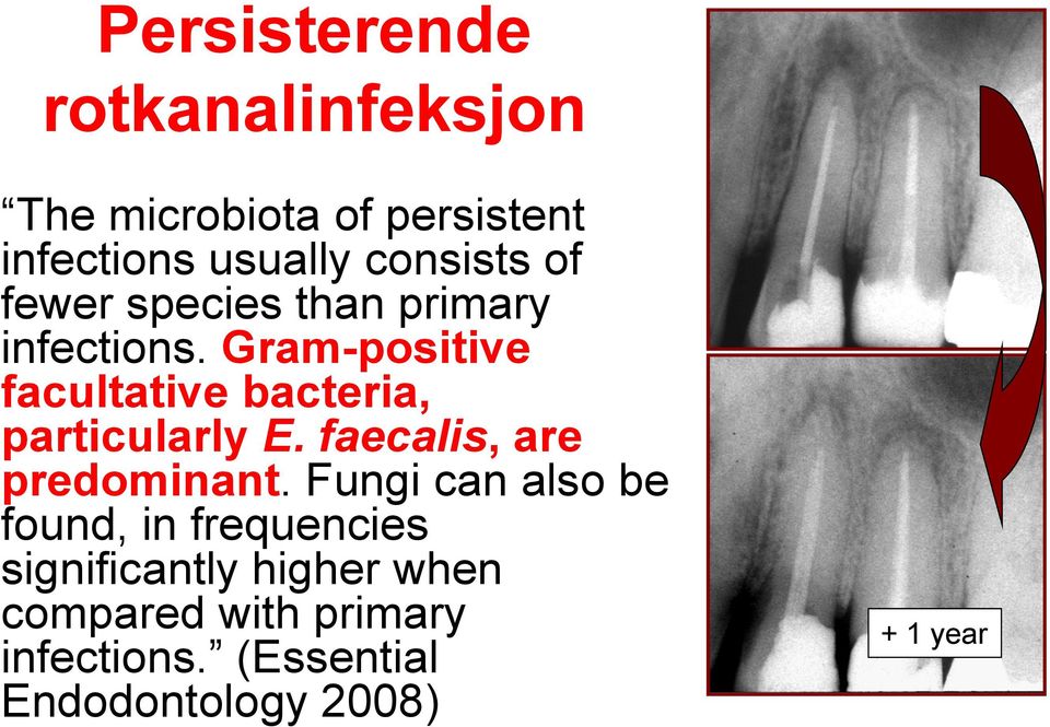 Gram-positive facultative bacteria, particularly E. faecalis, are predominant.