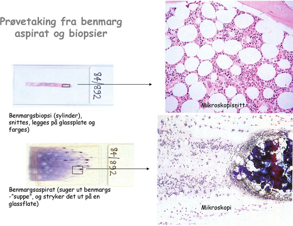 legges på glassplate og farges) Benmargsaspirat (suger