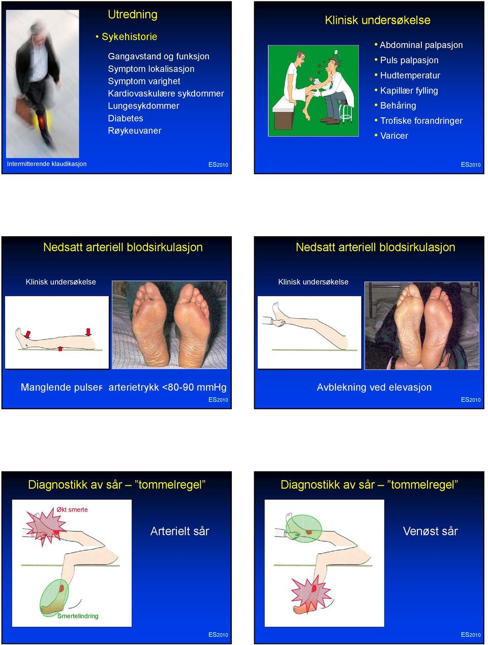 klaudikasjon Nedsatt arteriell blodsirkulasjon Nedsatt arteriell blodsirkulasjon Klinisk undersøkelse Klinisk undersøkelse Manglende pulser-