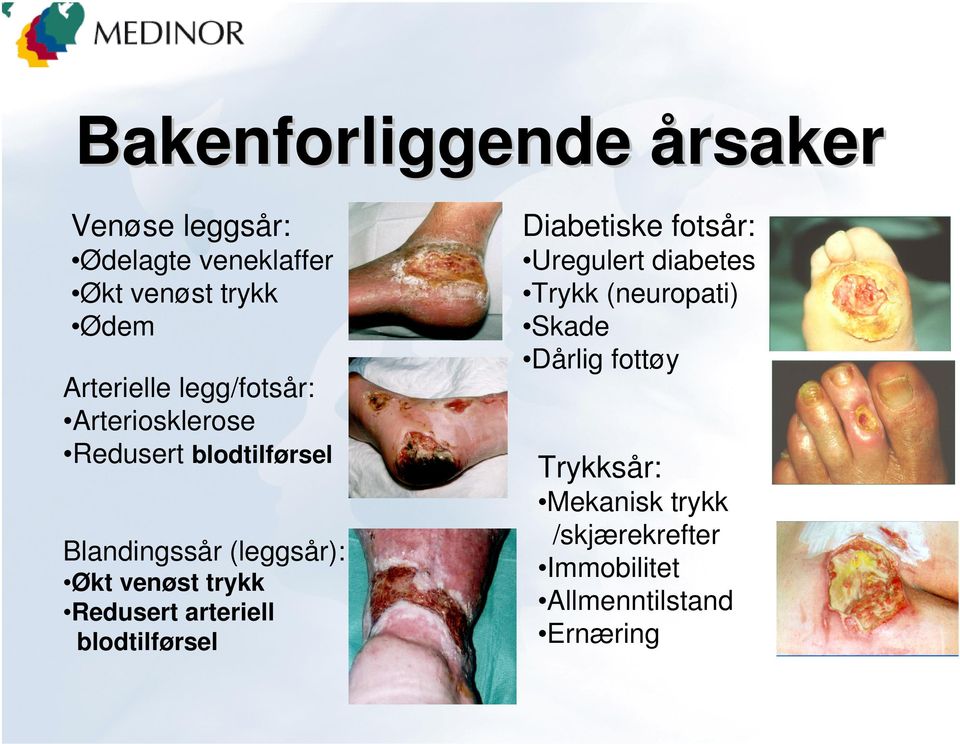 Arteriosklerose Redusert blodtilførsel Blandingssår (leggsår): Økt venøst trykk Redusert