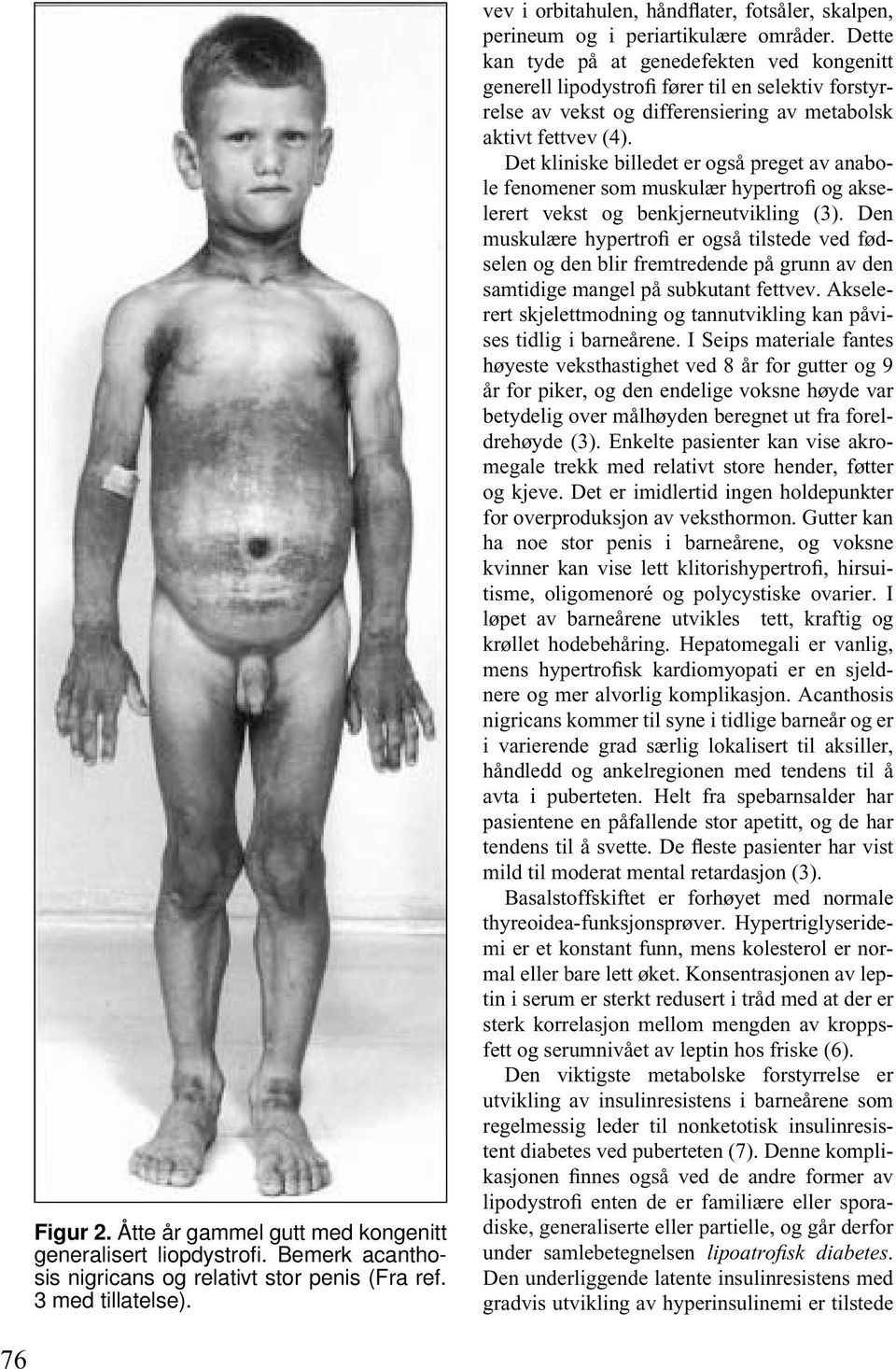 Dette kan tyde på at genedefekten ved kongenitt generell lipodystrofi fører til en selektiv forstyrrelse av vekst og differensiering av metabolsk aktivt fettvev (4).