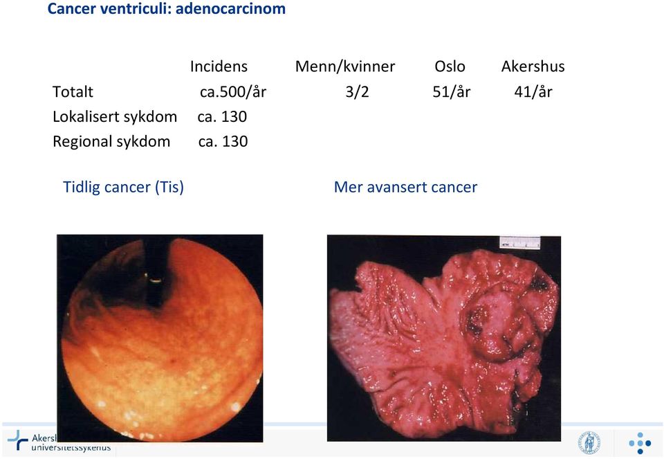 500/år 3/2 51/år 41/år Lokalisert sykdom ca.