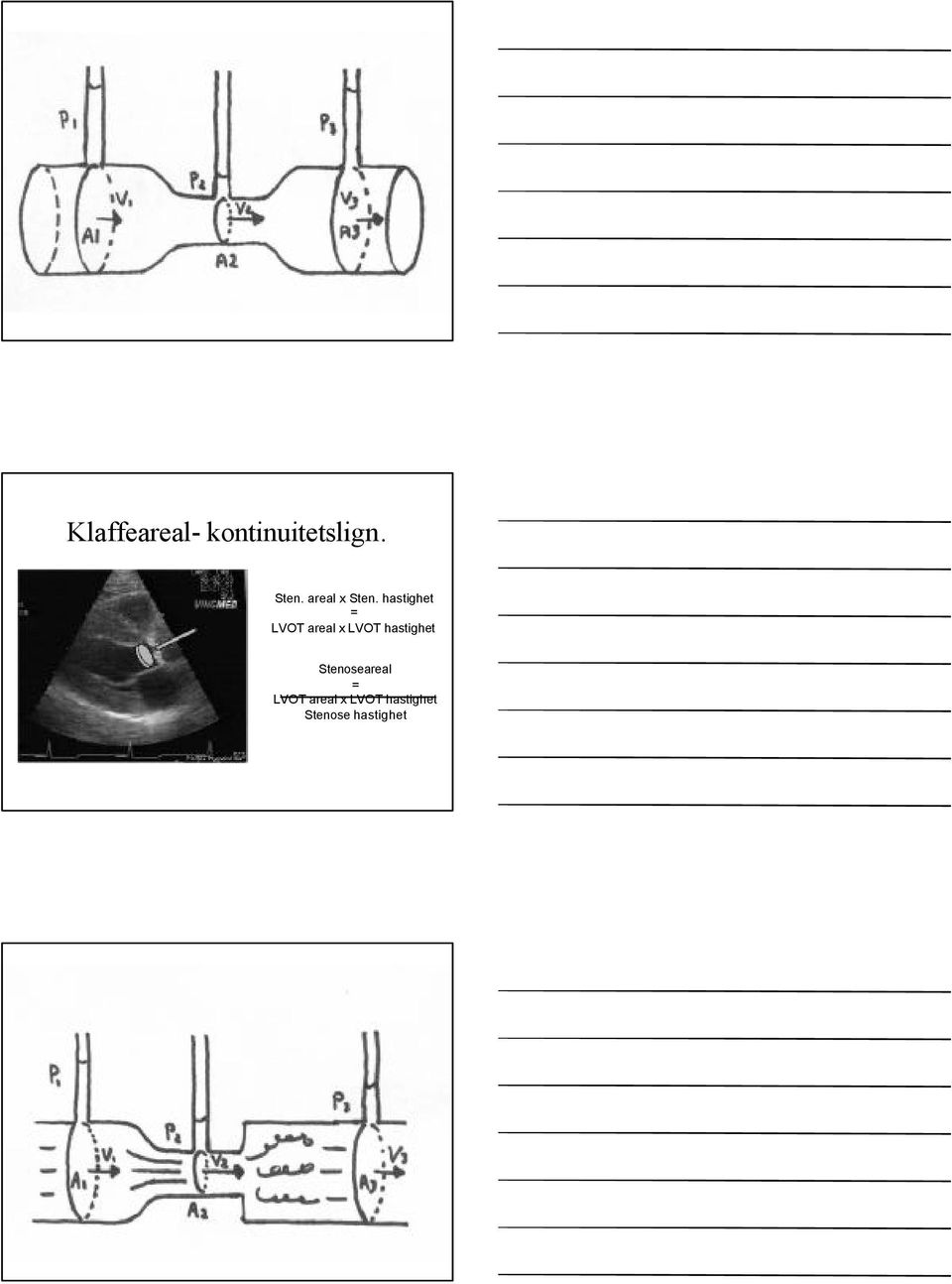 hastighet = LVOT areal x LVOT