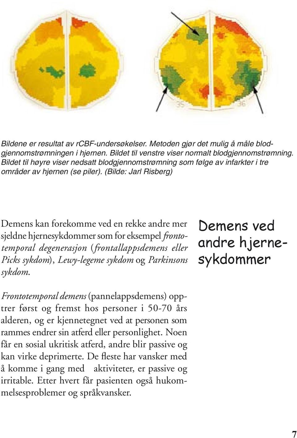 (Bilde: Jarl Risberg) Demens kan forekomme ved en rekke andre mer sjeldne hjernesykdommer som for eksempel frontotemporal degenerasjon (frontallappsdemens eller Picks sykdom), Lewy-legeme sykdom og