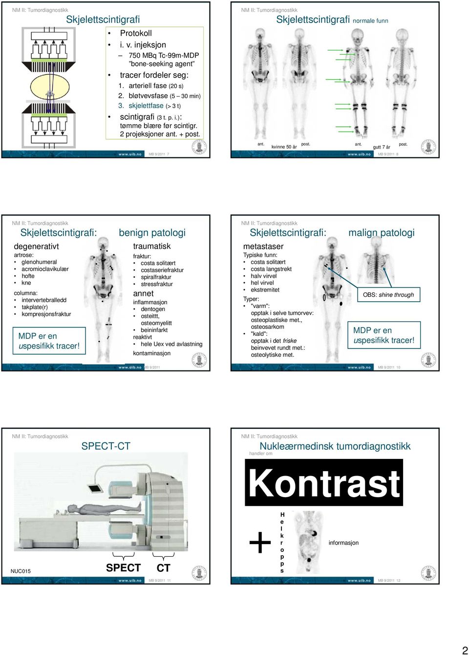 8 Skjelettscintigrafi: degenerativt artrose: glenohumeral acromioclavikulær hofte kne columna: intervertebralledd takplate(r) kompresjonsfraktur MDP er en uspesifikk tracer!