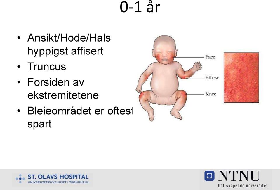 Forsiden av ekstremitetene