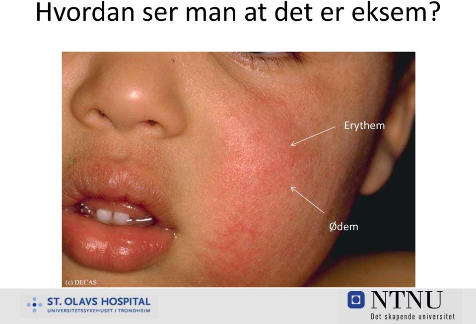 er eksem?