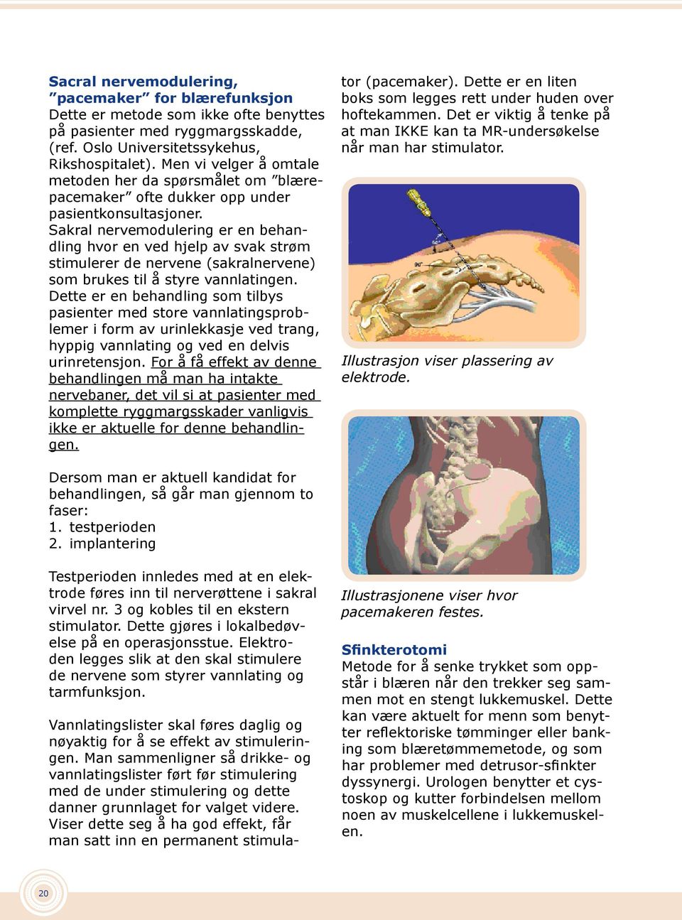 Sakral nervemodulering er en behandling hvor en ved hjelp av svak strøm stimulerer de nervene (sakralnervene) som brukes til å styre vannlatingen.