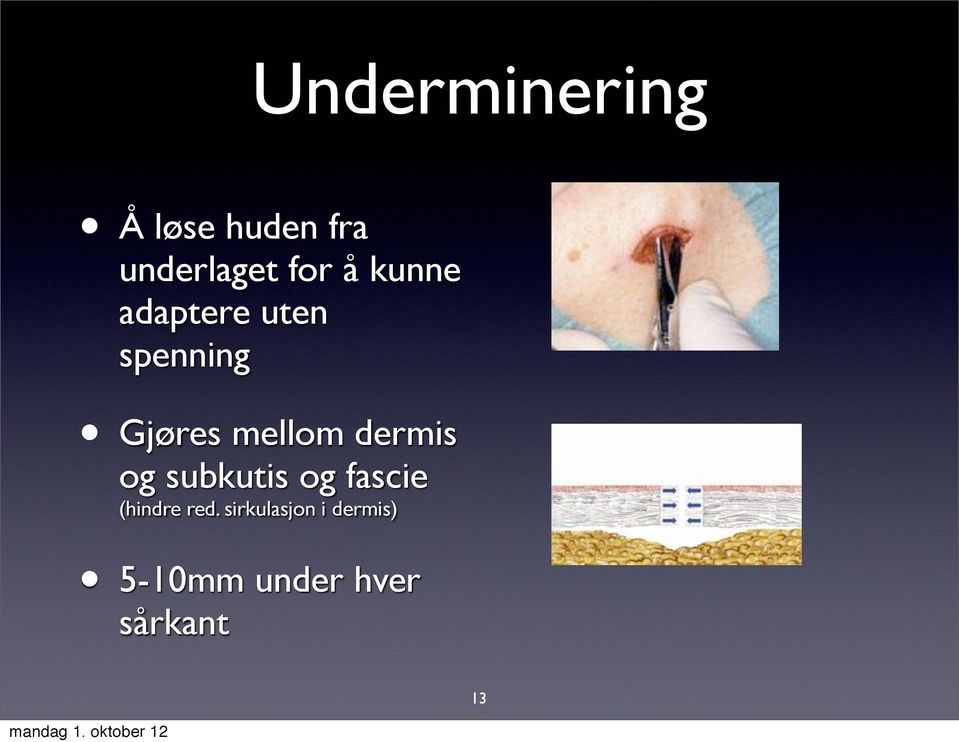 dermis og subkutis og fascie (hindre red.