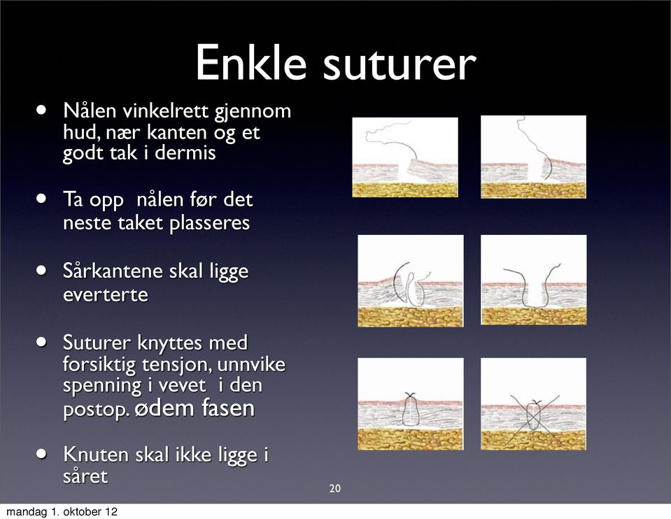 everterte Suturer knyttes med forsiktig tensjon, unnvike spenning i