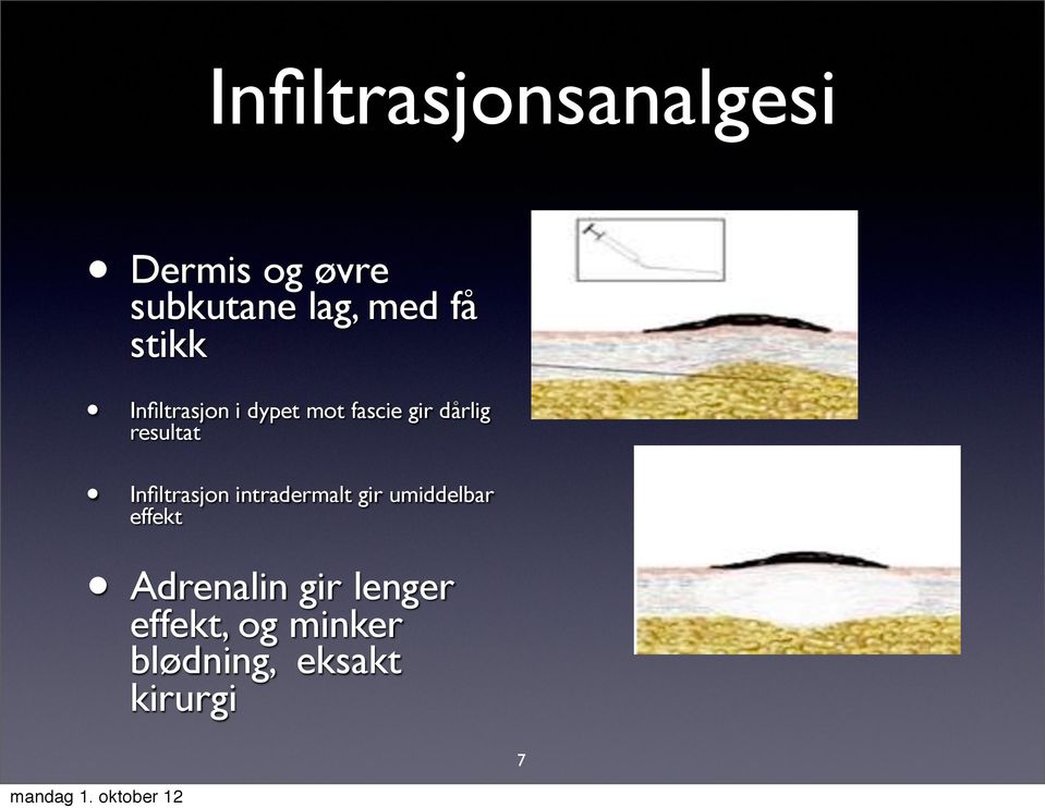 resultat Infiltrasjon intradermalt gir umiddelbar effekt