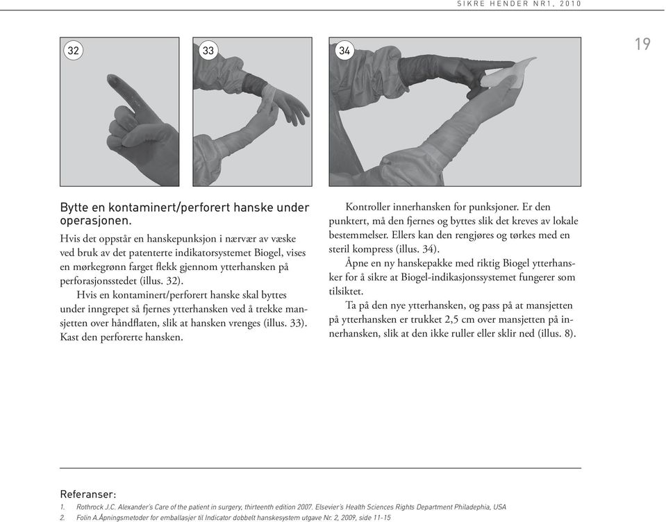 Hvis en kontaminert/perforert hanske skal byttes under inngrepet så fjernes ytterhansken ved å trekke mansjetten over håndflaten, slik at hansken vrenges (illus. 33). Kast den perforerte hansken.