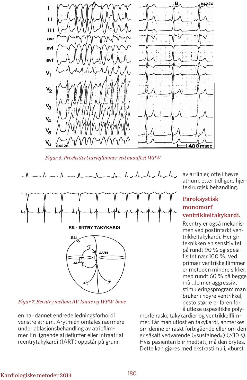 En lignende atrieflutter eller intraatrial reentrytakykardi (IART) oppstår på grunn Paroksystisk monomorf ventrikkeltakykardi. Reentry er også mekanismen ved postinfarkt ventrikkeltakykardi.