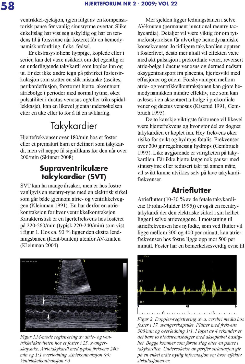 Er ekstrasystoliene hyppige, koplede eller i serier, kan det være usikkert om det egentlig er en underliggende takykardi som koples inn og ut.