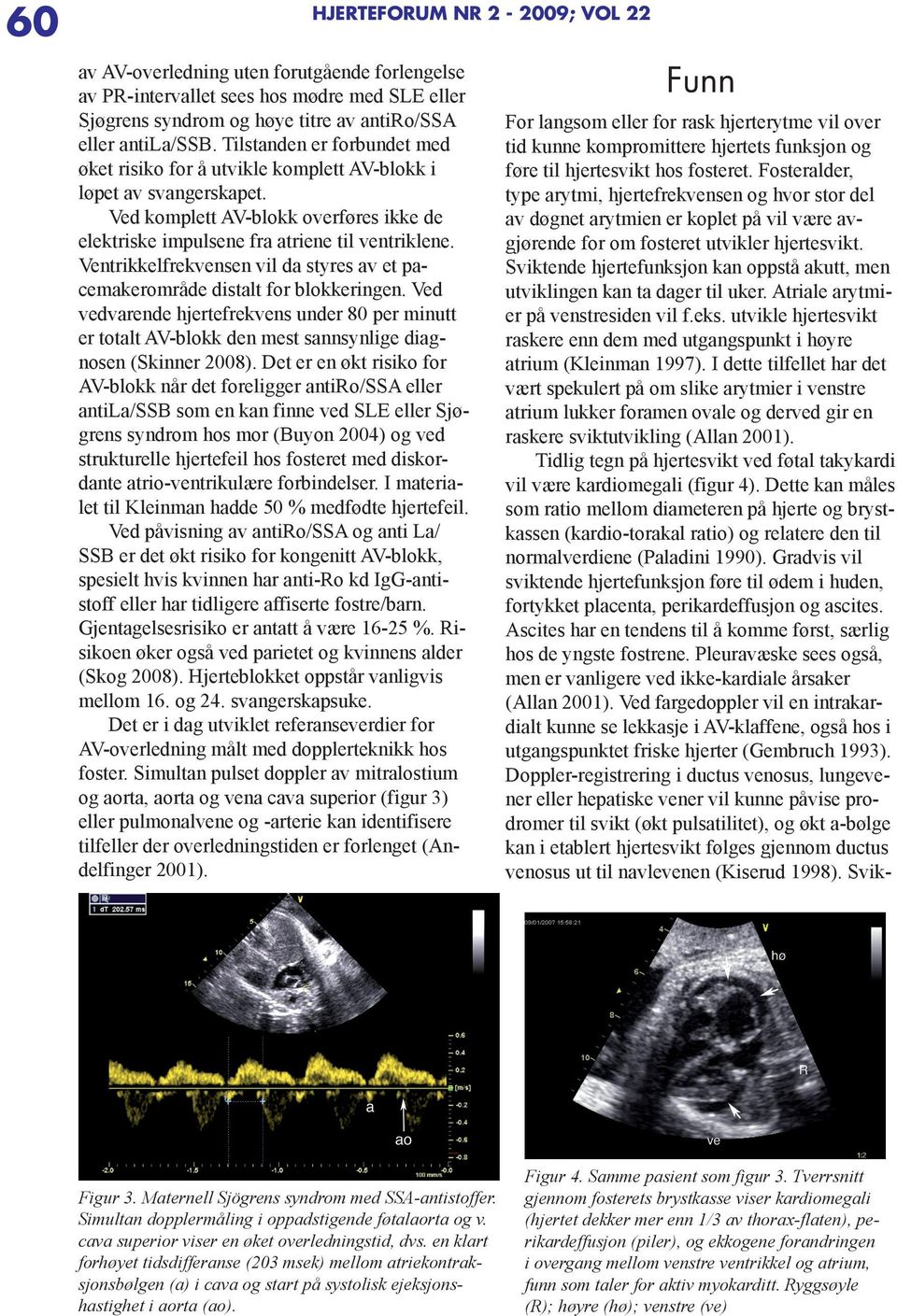 Ventrikkelfrekvensen vil da styres av et pacemakerområde distalt for blokkeringen. Ved vedvarende hjertefrekvens under 80 per minutt er totalt AV-blokk den mest sannsynlige diagnosen (Skinner 2008).